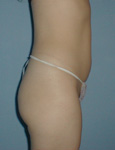 abdomen after treatment