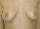 breasts after treatment